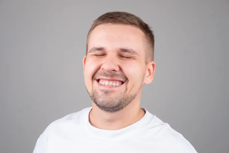 Пациент Orthodontica с керамическими брекетами
