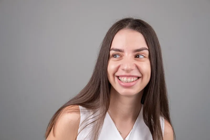 Пациент Orthodontica с керамическими брекетами