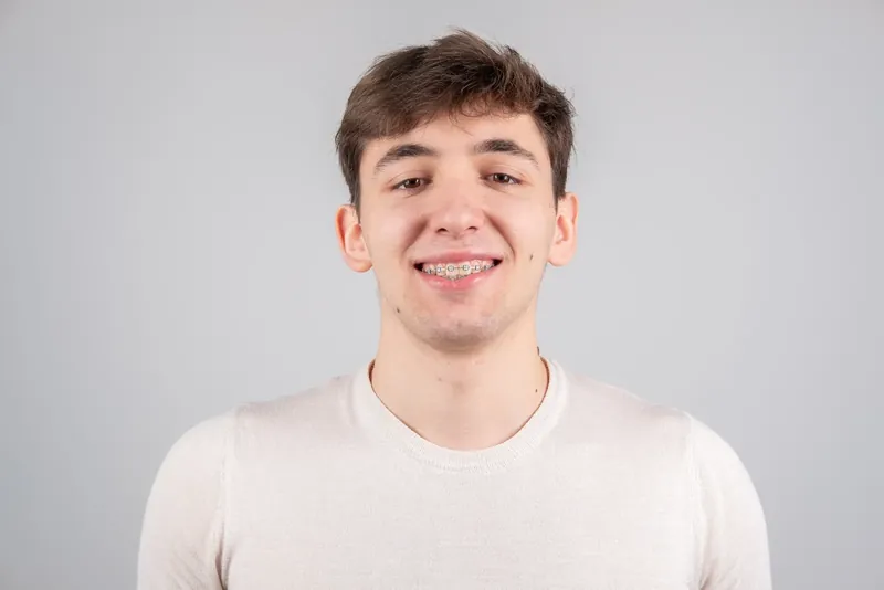 Пациент Orthodontica с керамическими брекетами