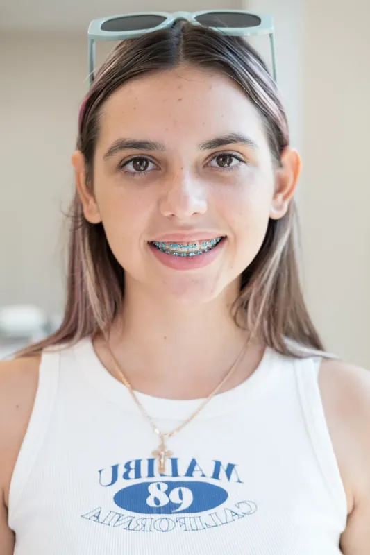 Пациент Orthodontica с металлическими брекетами