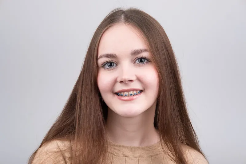 Пациент Orthodontica с металлическими брекетами