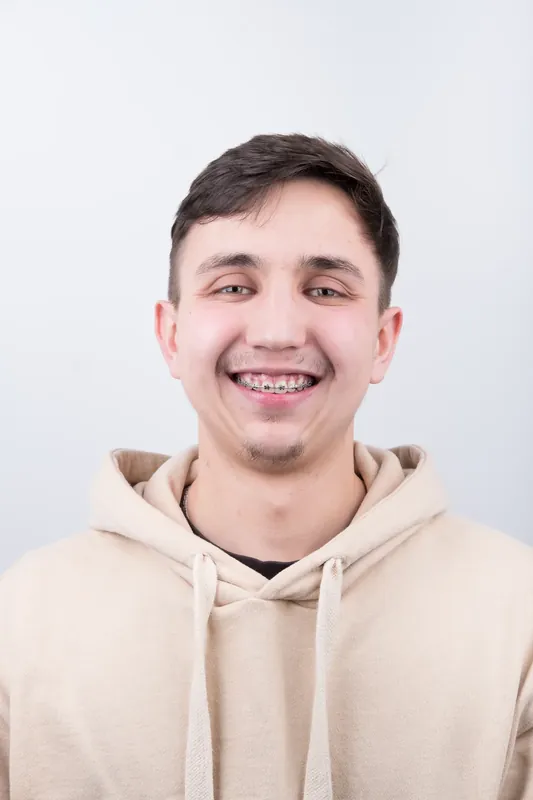 Пациент Orthodontica с металлическими брекетами