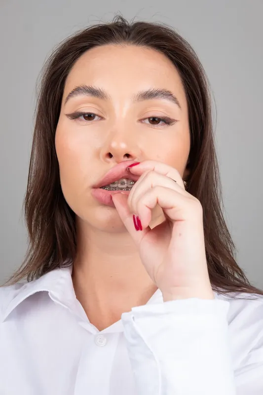 Пациент Orthodontica с металлическими брекетами