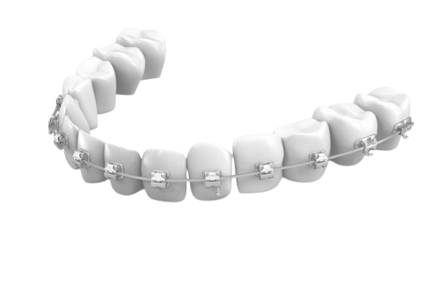 Родированные брекеты